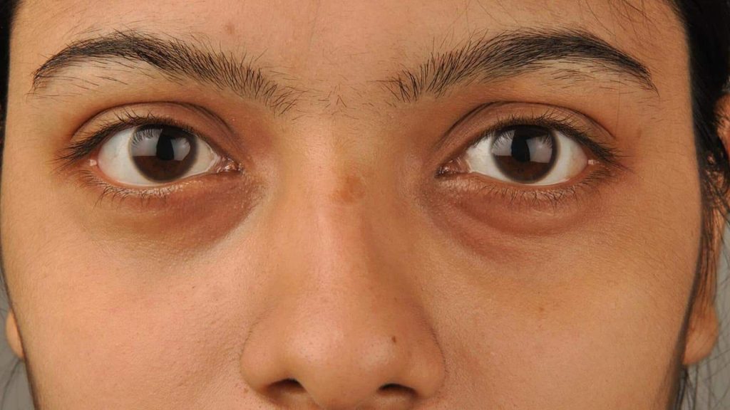 सर्दियों में सो कर उठने पर सूज जाती हैं आखें? आराम के लिए अपनाएं ये नुस्खे 