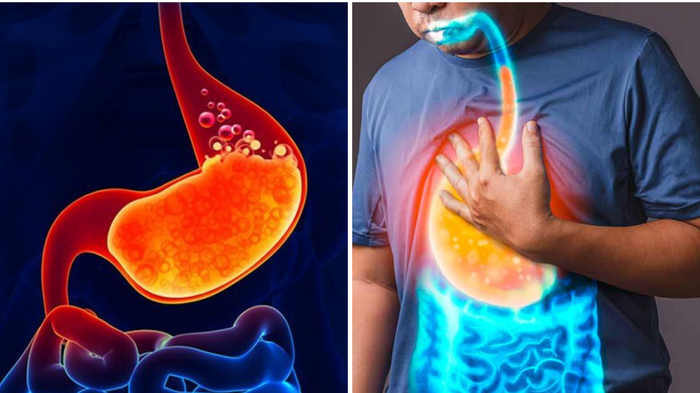 એસિડ રિફ્લક્સ ઉપાય: ખાટા બેલ્ચિંગમાં બર્નિંગ, નીચે જતા નથી? પેટનો એસિડ સમાપ્ત થઈ ગયો છે … acid reflux treatment