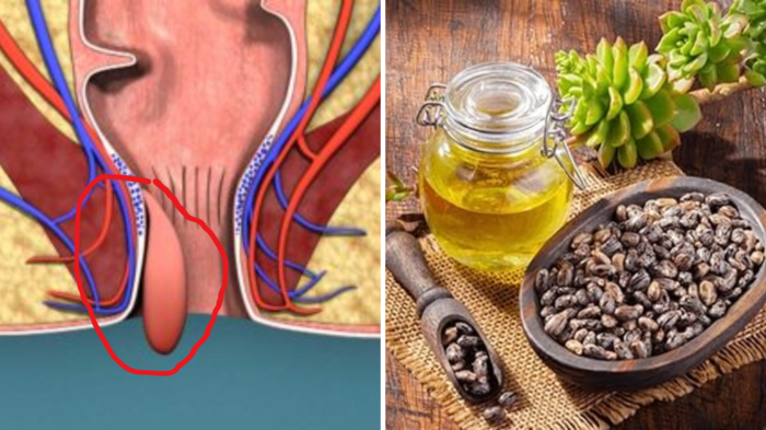 બાવાસીર કા ઇલાજ: પાઈલ્સ મસાઓ 14 દિવસમાં સુકાઈ જશે, આયુર્વેદ ડ Dr. એ 3 દેશી ટીપ્સને કહ્યું, … ayurveda dr saleem told 3 effective home remedies to treat piles or bawaseer at home in just 14 days