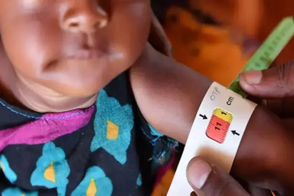 Tribal Child Malnutrition in Gujarat: ગુજરાતના વિકાસના દાવા સામે વાસ્તવિકતા, 3.21 લાખ આદિવાસી બાળકો હજુ પણ કુપોષણનો ભોગ