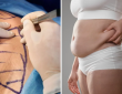 dr ashish from max hospital told is bariatric surgery good for weight loss and who is eligible