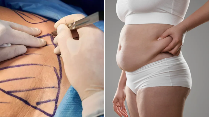 વજન ઘટાડવા માટે બેરીઆટ્રિક સર્જરી: વજન ઓછું કરવા માટે બેરીઆટ્રિક સર્જરી, કેટલું સલામત, અસરકારક, કોણ … dr ashish from max hospital told is bariatric surgery good for weight loss and who is eligible