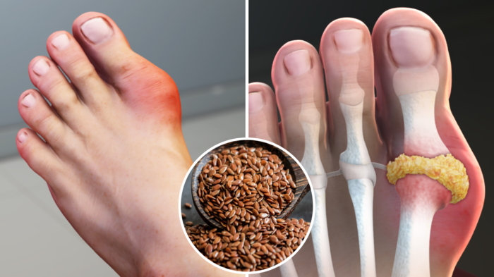 શરીરમાંથી યુરિક એસિડને કેવી રીતે દૂર કરવું: કિડનીમાં કાંકરા ભરવામાં આવશે, સાંધા ઉમેરવામાં આવશે, 5 રીતે સમાપ્ત થશે … nutritionist rajmani told 5 effective ways to decrease uric acid level in body and prevent gout and kidney stones