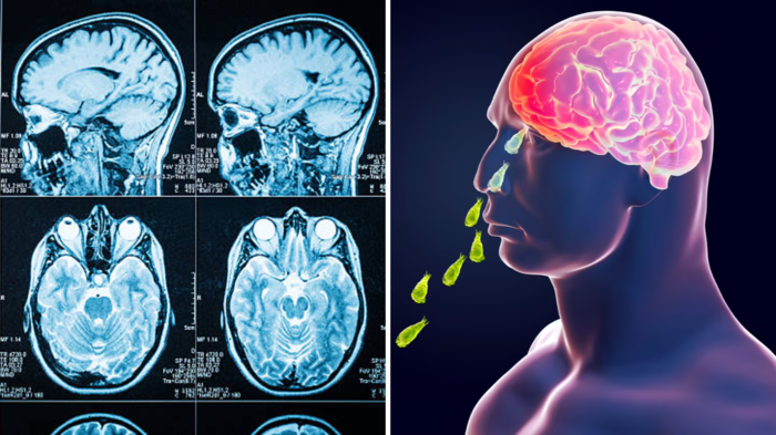 કેરળમાં ‘મગજ -ઇટિંગ રોગ’ ને કારણે 19 લોકો મૃત્યુ પામ્યા, ડો. ચેતવણી -એલાન્ટ … brain diseases