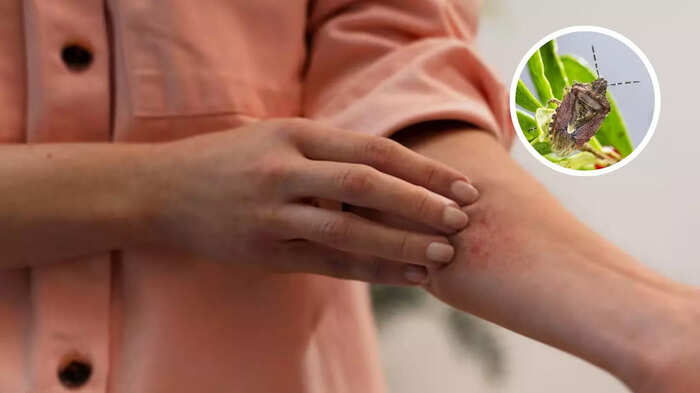 અમેરિકાની વિરલ ચુંબન ભૂલ, 32 રાજ્યોમાં કેસના કેસ … Chagas disease