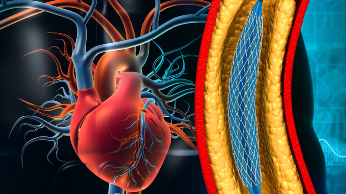 કોઈ ફાડી નહીં, રક્તસ્રાવ નહીં, તમે સરળતાથી જાણશો કે ત્યાં કેટલા અવરોધ છે? ડ doctor ક્ટર … check heart blockage
