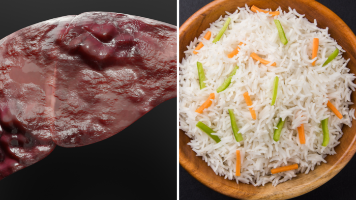 ખાન સરએ કહ્યું કે યકૃત રોટનું સૌથી મોટું કારણ, તેલ ગંદકી વિના ફેલાય છે … fatty liver causing food