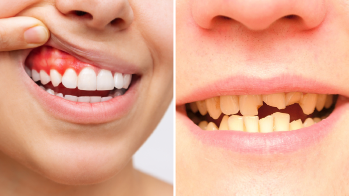 દાંત ચમકવાનો કોઈ ફાયદો નથી, ત્યાં સુધી તમે દંત ચિકિત્સક, ડોકટરોને કહો નહીં … gum health tips oral health