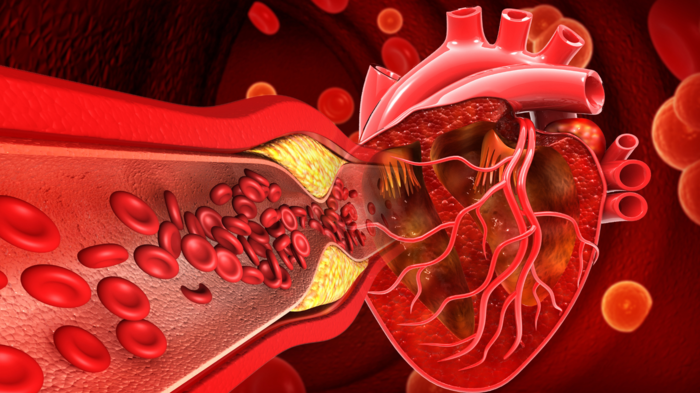 હાર્ટ એટેકને કેવી રીતે રોકવું: 10 વર્ષ પહેલાં, હાર્ટ એટેકનું જોખમ જાણીતું હશે, ડ doctor ક્ટરે 3 ઉપાય કહ્યું, … high cholesterol blocked heart artery