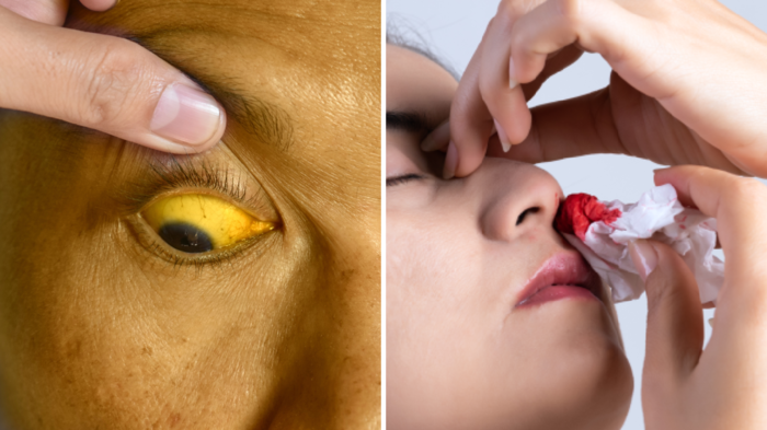 લ્યુકેમિયા ડે ’25: શું તમે પીળી આંખો, કમળો સમજો છો? આ આ બ્લડ કેન્સરને છેતરપિંડી કરી શકે છે … leukemia blood cancer symptom