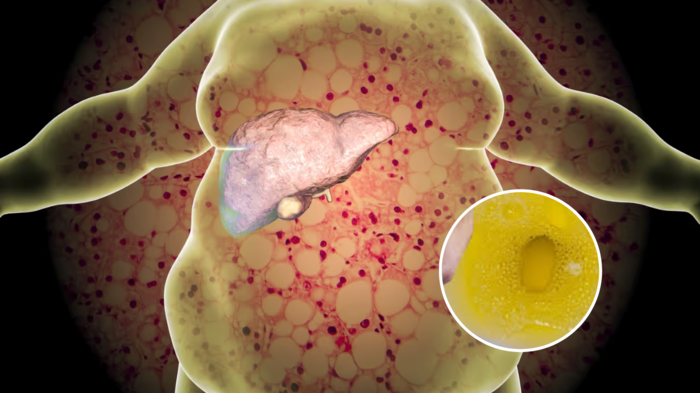 યકૃતને શાંતિથી સડવાનું, 5 લક્ષણો ડોજિંગ, ગેસ્ટરલોજિસ્ટની ચેતવણી … liver damage symptoms in hindi