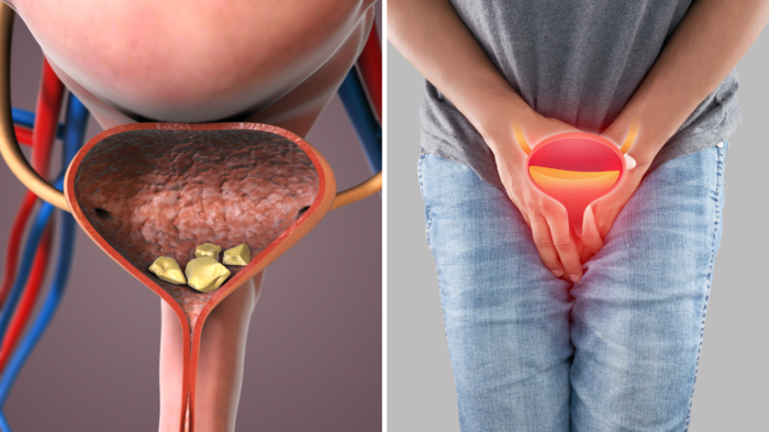 પેશાબ છોડો, ધારનું નબળું થવું, એટલે કે મૂત્રાશયમાં કચરો અટવાયો, સફાઈ … urinary bladder stone symptoms