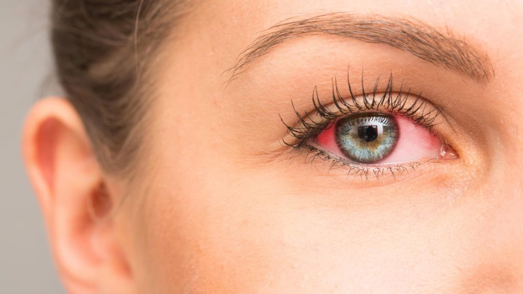 आंखों की खुजली से परेशान हैं? इन घरेलू नुस्खों को आजमाएं