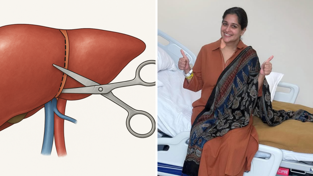 dipika kakar liver cancer treatment