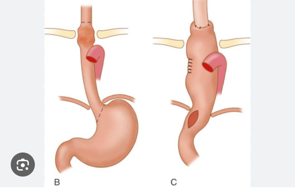 સિવિલ હોસ્પિટલમાં 15 મહિનાના બાળકની હોજરી ખેંચી અન્નનળી બનાવાઈ