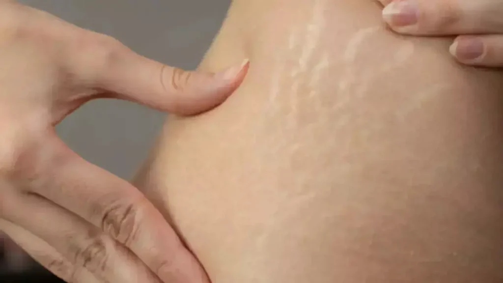 Health Update: जिद्दी स्ट्रेच मार्क्स से छुटकारा पाने के घरेलू नुस्खे